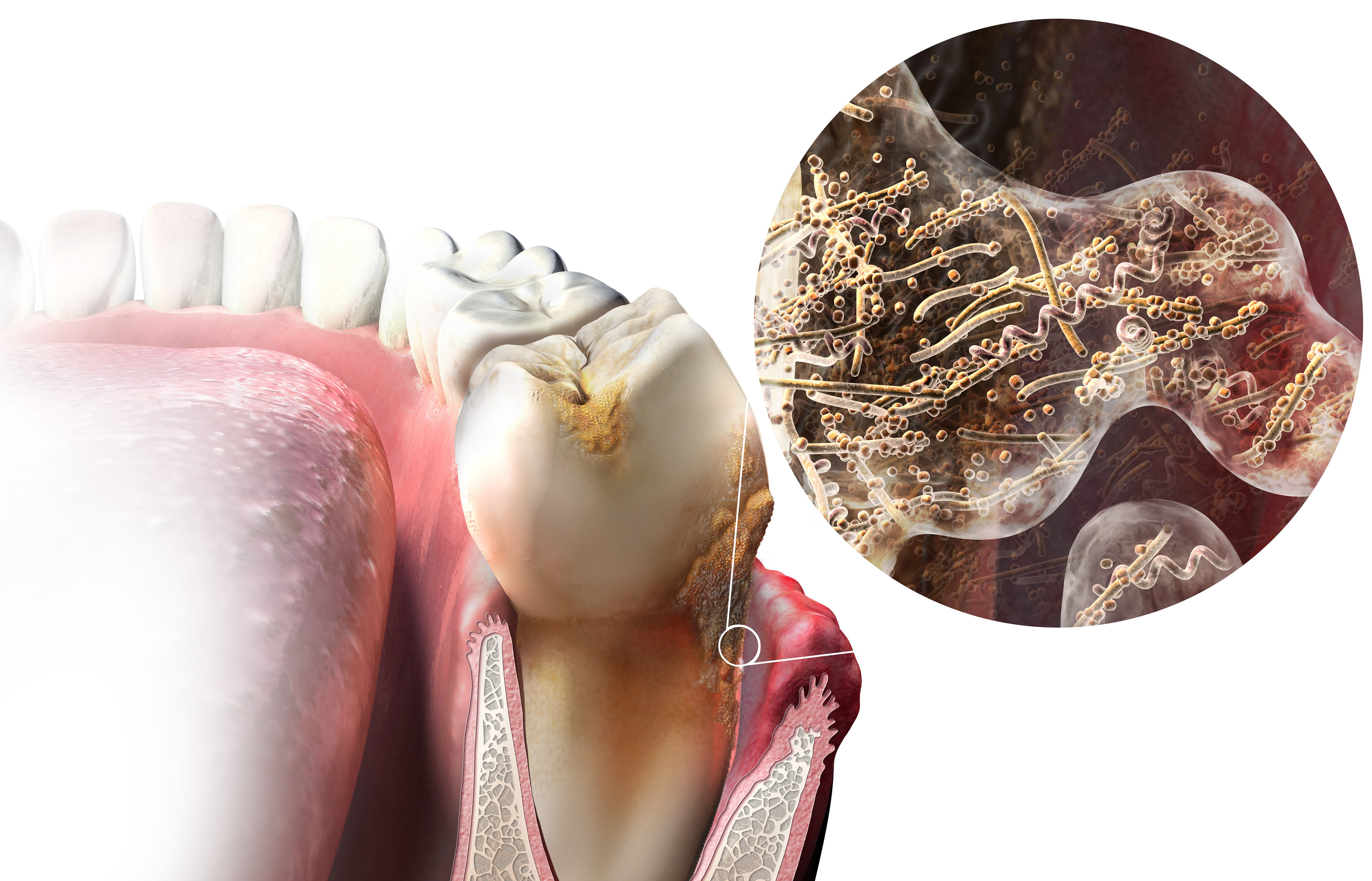 Explain Dental Plaque As A Biofilm Community