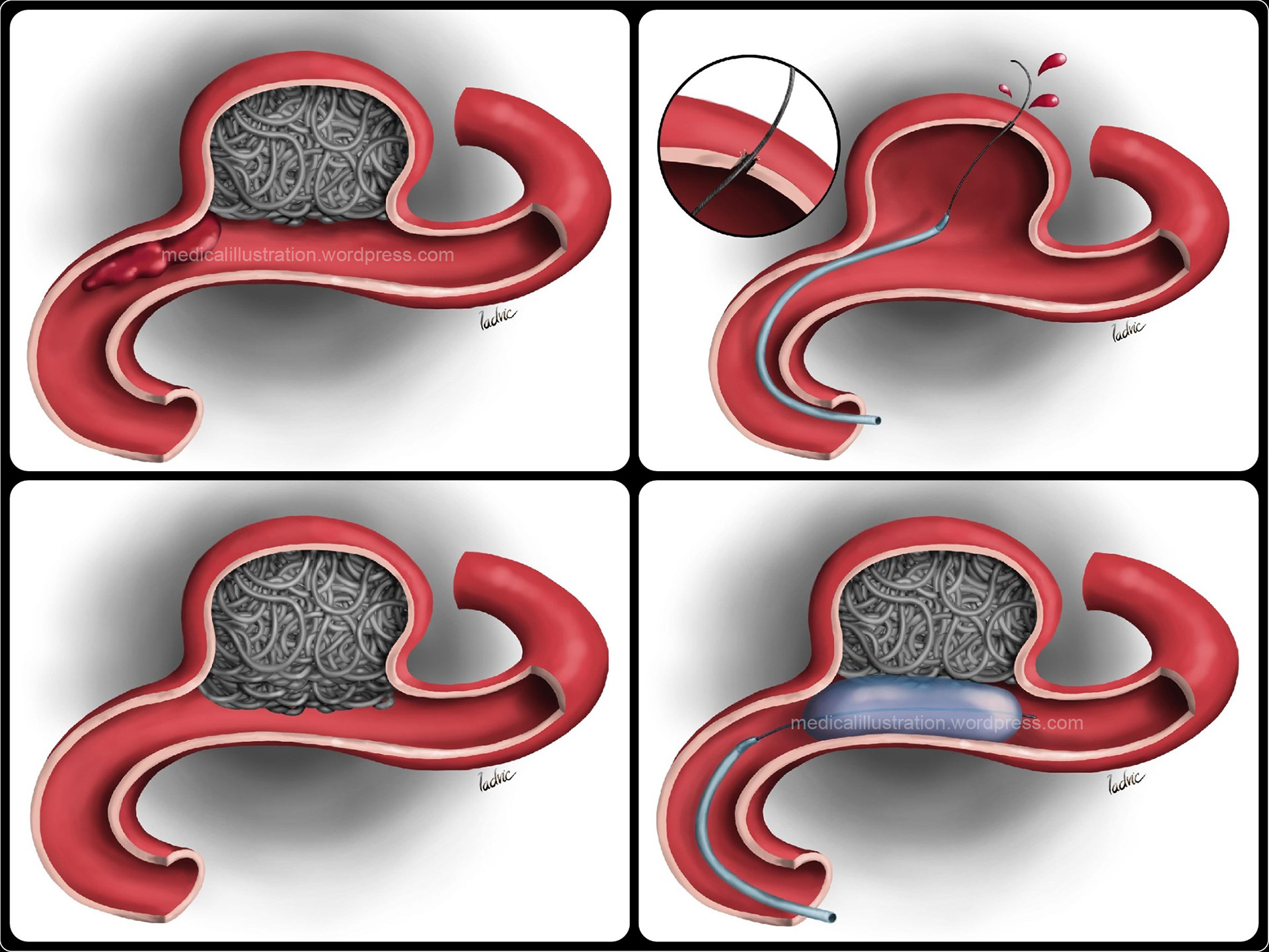 Ladvic Medical illustration Aneurysm Coiling Complications