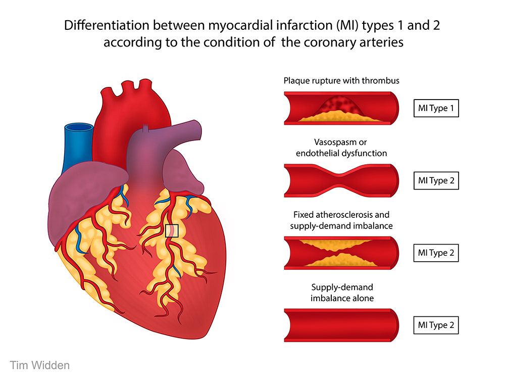 Tim Widden | Forensic Art - Coronary artery disease