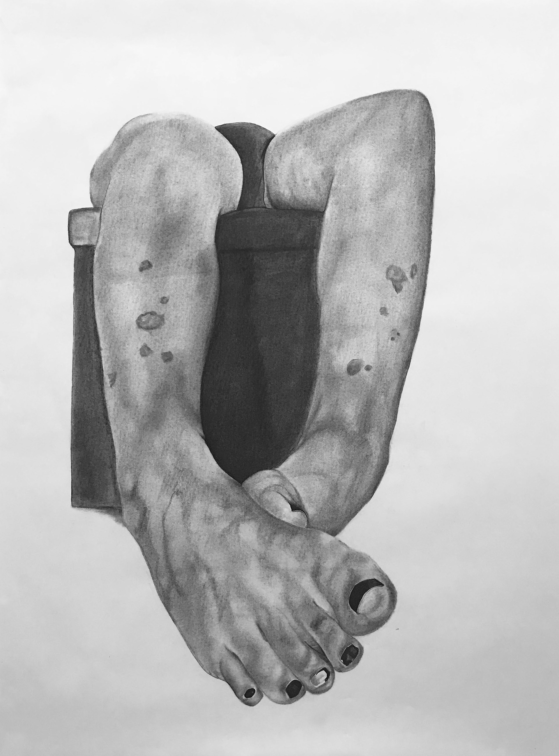 Large scale charcoal drawing of disembodied legs covered in skin lesions. Drawing is on drawing paper.