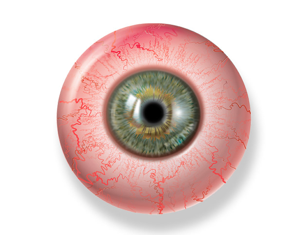 Irritated Eye