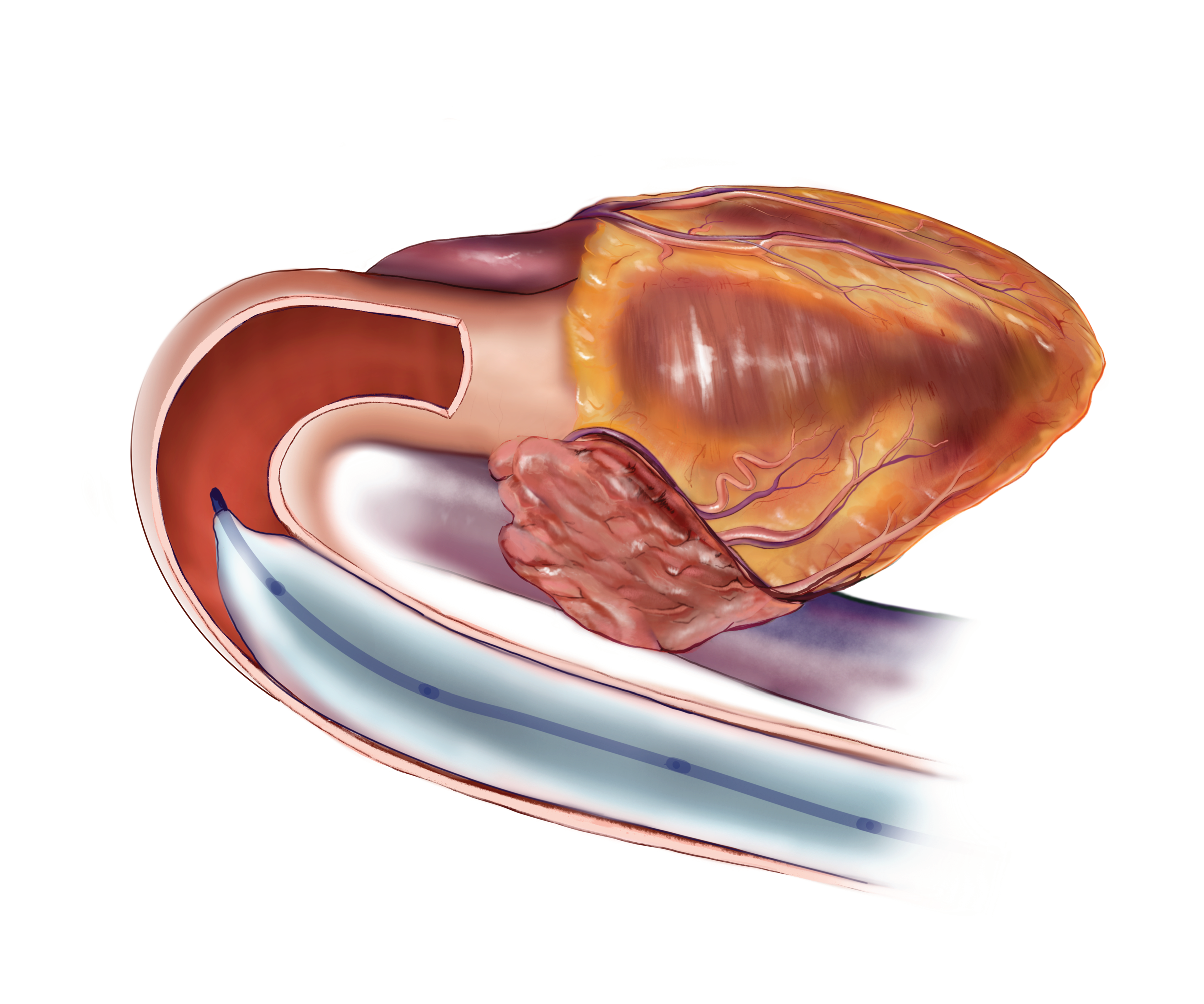 Intra-aortic balloon pump