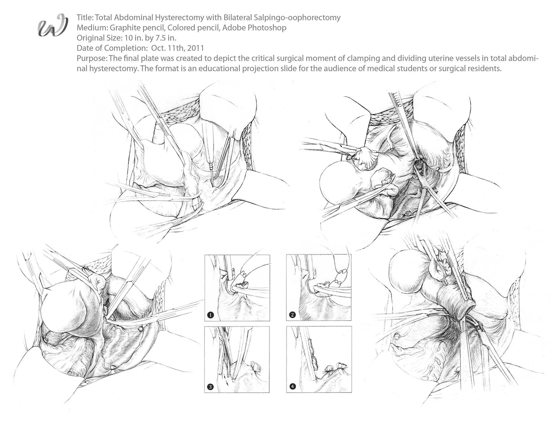 sketch for total abdominal hysterectomy